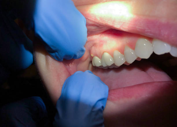 Best Urgent Tooth Repair  in Interlaken, CA