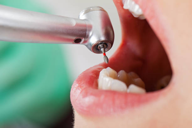 Best Emergency Tooth Extraction  in Interlaken, CA